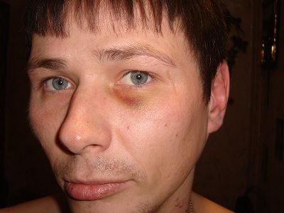 Нижегородец Алексей Никитин после пыток в полиции. Фото: КПП